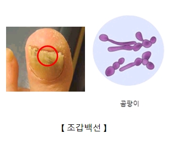 조갑백선(Tinea unguium) | 질환백과 | 의료정보 | 건강정보 | 서울아산병원
