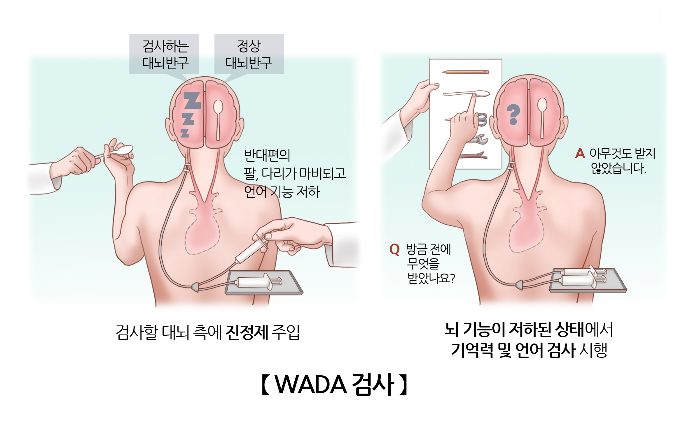 WADA 검사(Wada test) | 검사/시술/수술정보 | 의료정보 | 건강정보 | 서울아산병원